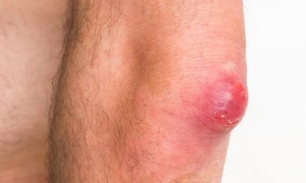 Kondisi Tubuh Bisulan Akibat Beberapa Penyebab Bakteri