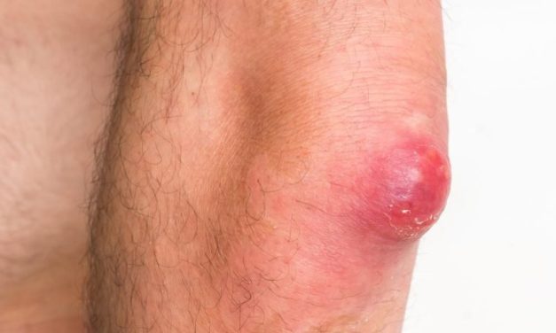 Kondisi Tubuh Bisulan Akibat Beberapa Penyebab Bakteri