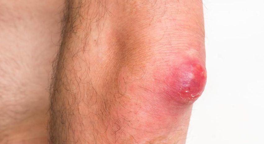 Kondisi Tubuh Bisulan Akibat Beberapa Penyebab Bakteri