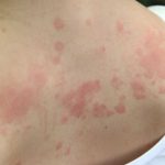 Kondisi Peradangan Kulit Dermatitis Yang Menyebabkan Gatal