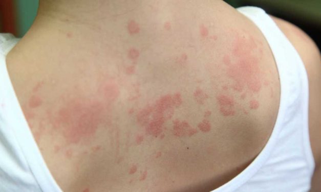 Kondisi Peradangan Kulit Dermatitis Yang Menyebabkan Gatal