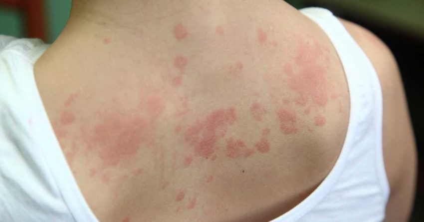 Kondisi Peradangan Kulit Dermatitis Yang Menyebabkan Gatal